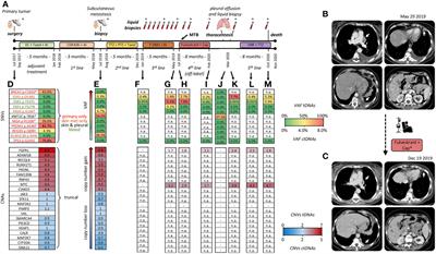 Unusual phylogenetic tree and circulating actionable ESR1 mutations in an aggressive luminal/HER2-low breast cancer: Case report